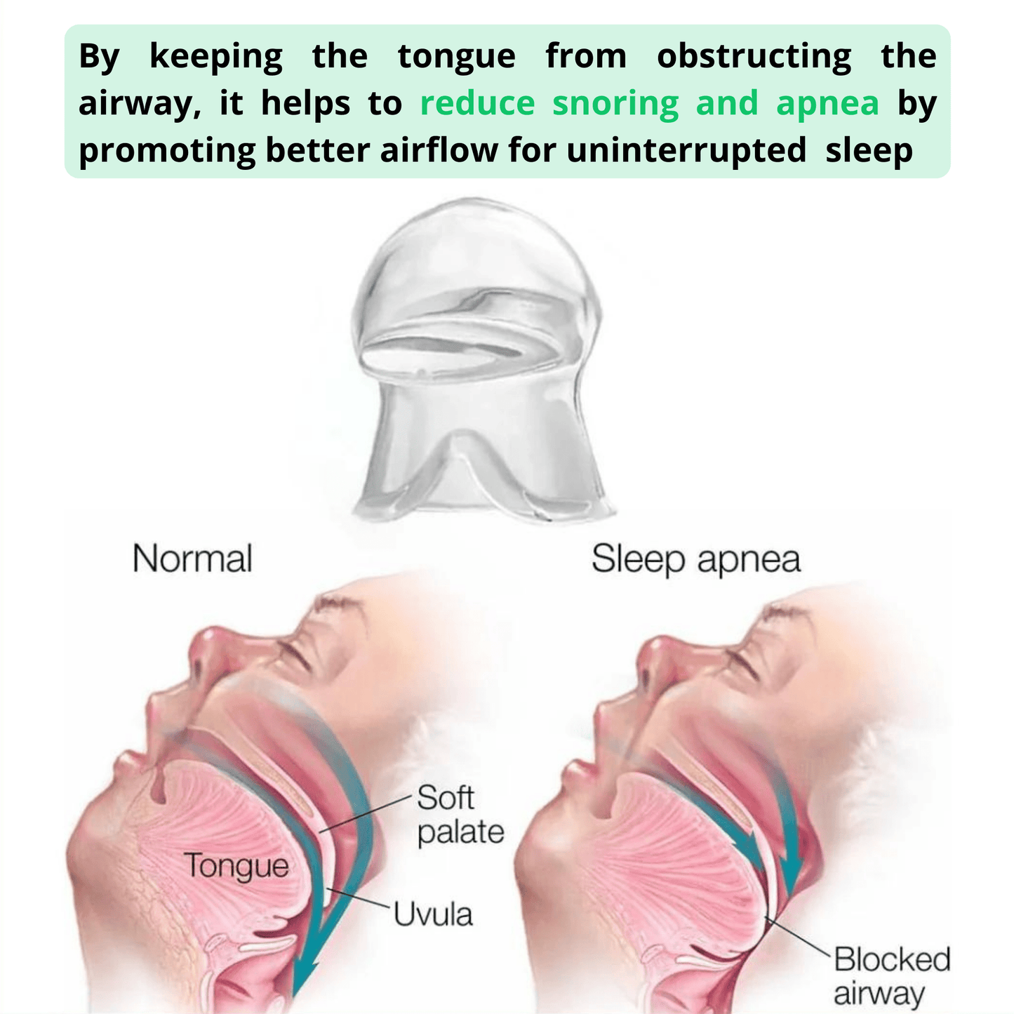 Anti-Snoring Tongue Retainer - Stop Snoring Instantly - Snorestop PRO