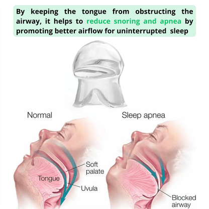 Anti-Snoring Tongue Retainer - Stop Snoring Instantly - Snorestop PRO